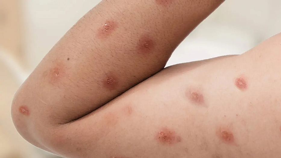 Brasil registra 88 casos de Mpox em 2026 saiba como evitar a doença